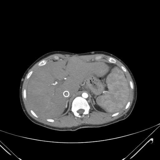 File:Nutmeg liver- Budd-Chiari syndrome (Radiopaedia 46234-50635 A 20).png