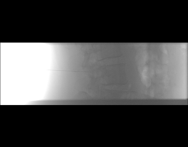 File:Oblique sublaminar lumbar puncture (Radiopaedia 90103-107280 A 4).jpeg