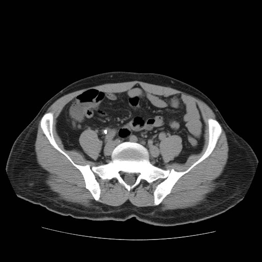 File:Obstructed kidney with perinephric urinoma (Radiopaedia 26889-27067 Axial non-contrast 31).jpg