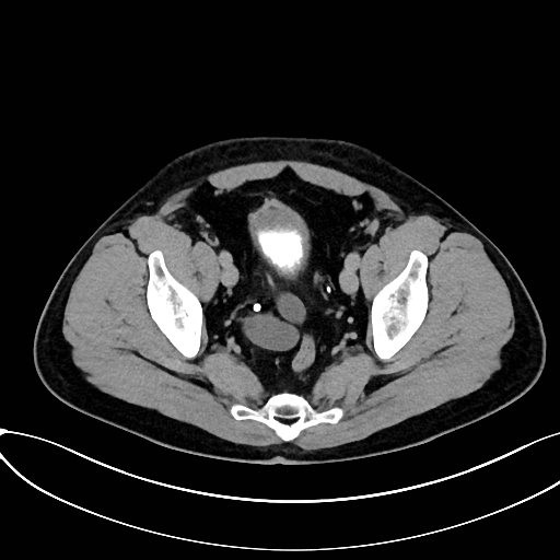Obstructed upper pole ureter in a duplex kidney (Radiopaedia 54935-61221 Axial C+ delayed 94).jpg