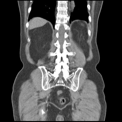 Obstructing renal calculus (Radiopaedia 29517-30016 Coronal non-contrast 42).jpg
