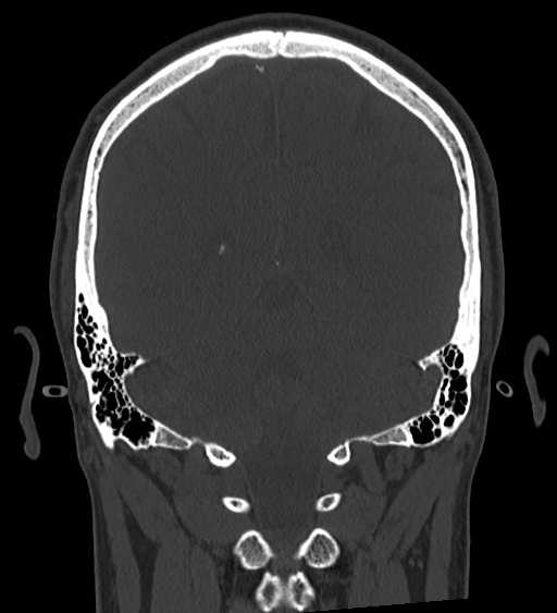 Occipital spur and Currarino type A atlas anomaly (Radiopaedia 87027-103285 Coronal bone window 103).jpg