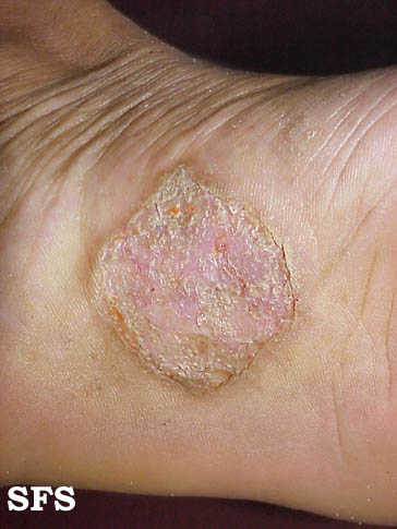 File:Psoriasis (Dermatology Atlas 22).jpg