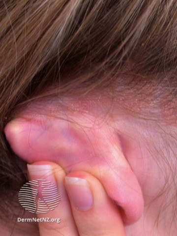 File:Seborrhoeic dermatitis (DermNet NZ site-age-specific-ear-seborrhoeic-dermatitis).jpg