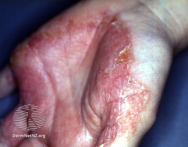 File:Zoophilic tinea infection (DermNet NZ tinea-manuum-01).jpg