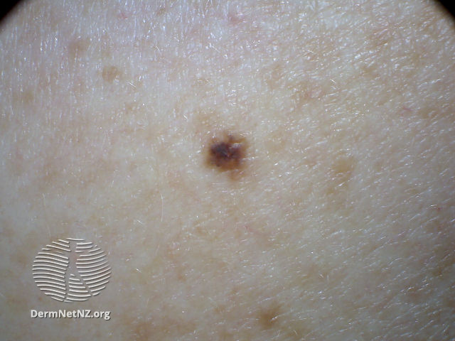 File:2013 (DermNet NZ melanoma-abcds-19).jpg