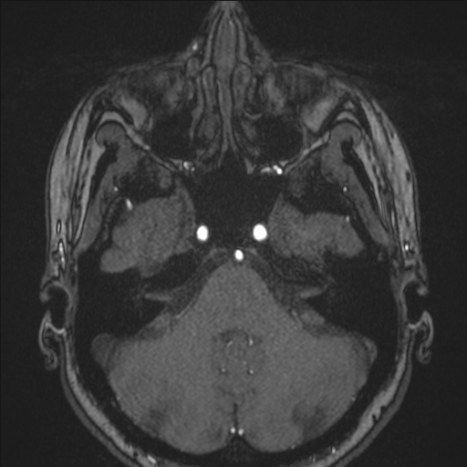 A1 segment hypoplasia (Radiopaedia 83365-97781 Axial TOF MRA 35).jpg