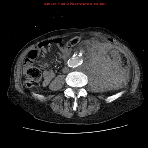 Abdominal aortic aneurysm- extremely large, ruptured (Radiopaedia 19882-19921 Axial C+ arterial phase 45).jpg