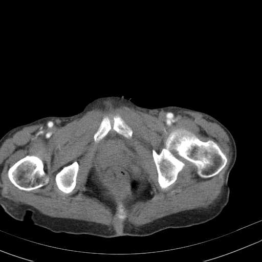 File:Abdominal aortic aneurysm (Radiopaedia 20827-20742 Axial C+ arterial phase 41).jpg