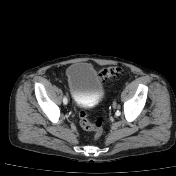 Abdominal aortic aneurysm (Radiopaedia 29248-29660 Axial C+ arterial phase 76).jpg