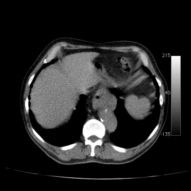 Abdominal aortic aneurysm (Radiopaedia 29248-29660 Axial non-contrast 10).jpg