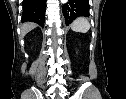 Abdominal aortic aneurysm (Radiopaedia 67117-76452 Coronal C+ arterial phase 89).jpg