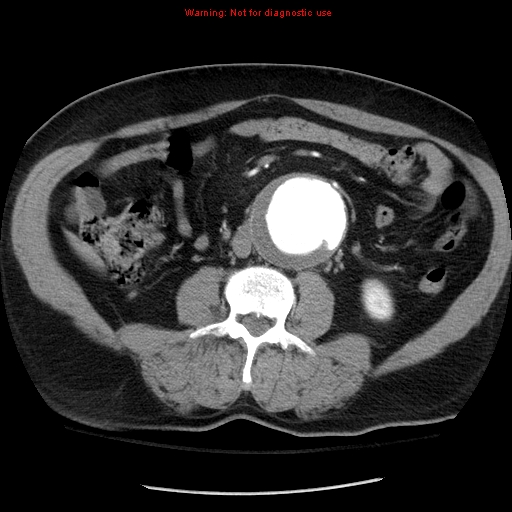 File:Abdominal aortic aneurysm (Radiopaedia 8190-9038 Axial C+ arterial phase 43).jpg