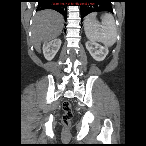 Abdominal aortic aneurysm (Radiopaedia 8190-9038 Coronal C+ arterial phase 95).jpg
