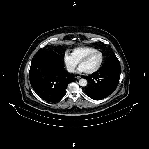 Abdominal aortic aneurysm (Radiopaedia 83094-97462 Axial renal cortical phase 53).jpg