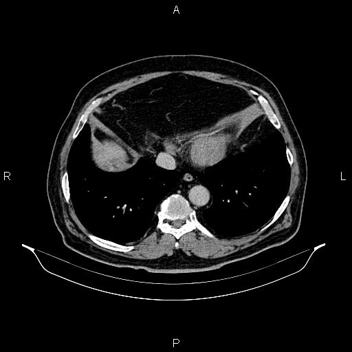 File:Abdominal aortic aneurysm (Radiopaedia 83094-97462 Axial renal excretory phase 11).jpg