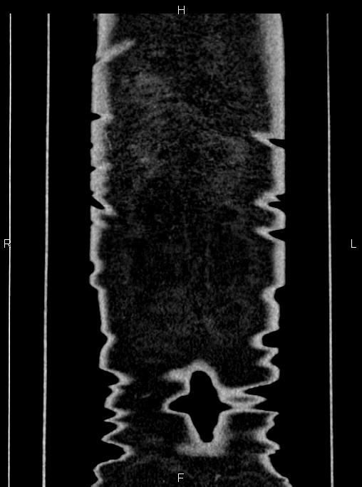 Abdominal aortic aneurysm (Radiopaedia 83094-97462 Coronal renal cortical phase 94).jpg