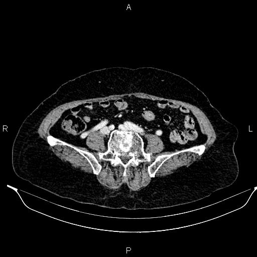 File:Abdominal aortic aneurysm (Radiopaedia 85063-100606 Axial C+ portal venous phase 50).jpg