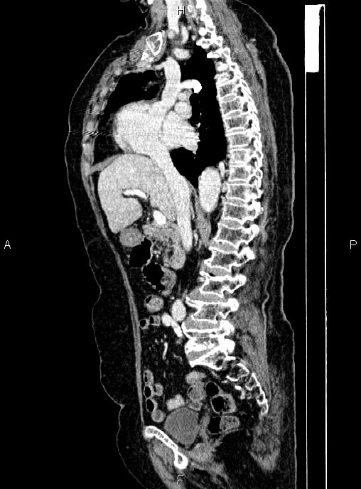Abdominal aortic aneurysm (Radiopaedia 85063-100606 Sagittal C+ arterial phase 34).jpg