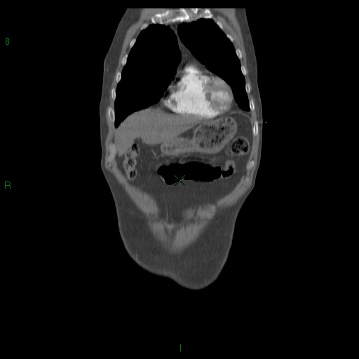 File:Abdominal aortic aneurysm rupture with aortocaval fistula (Radiopaedia 14897-14841 Coronal C+ arterial phase 16).jpg