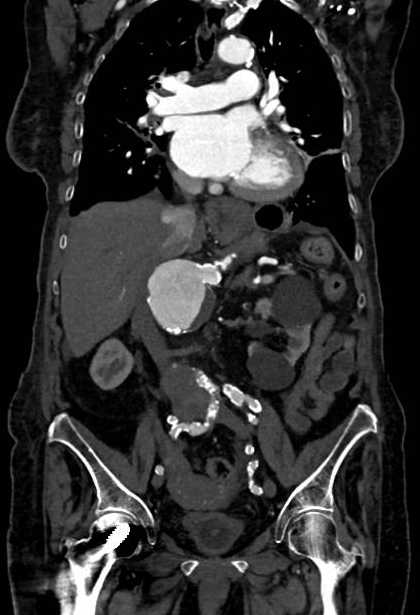 Abdominal aortic aneurysm with thrombus fissuration (Radiopaedia 73192-83919 Coronal C+ arterial phase 41).jpg