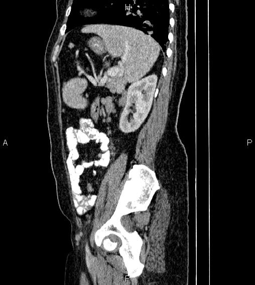 Abdominal lymphoma with sandwich sign (Radiopaedia 84378-99704 Sagittal C+ portal venous phase 69).jpg