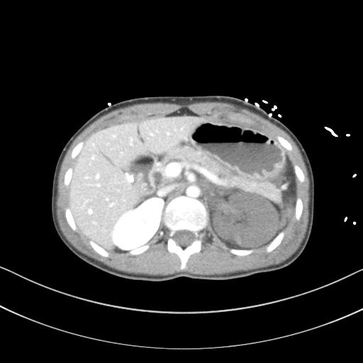 Abdominal multi-trauma - devascularised kidney and liver, spleen and pancreatic lacerations (Radiopaedia 34984-36486 Axial C+ portal venous phase 25).png
