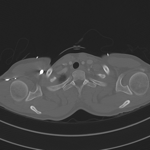 File:Abdominal multi-trauma - devascularised kidney and liver, spleen and pancreatic lacerations (Radiopaedia 34984-36486 I 10).png