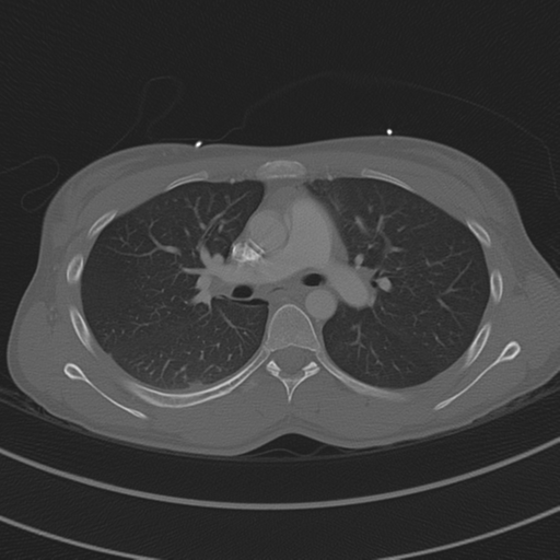File:Abdominal multi-trauma - devascularised kidney and liver, spleen and pancreatic lacerations (Radiopaedia 34984-36486 I 36).png