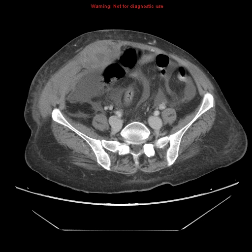 File:Abdominal wall hematoma (Radiopaedia 9427-10112 Axial C+ portal venous phase 76).jpg