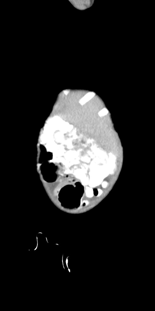 Abdominopelvic rhabdomyosarcoma (Radiopaedia 78356-90984 Sagittal C+ portal venous phase 94).jpg