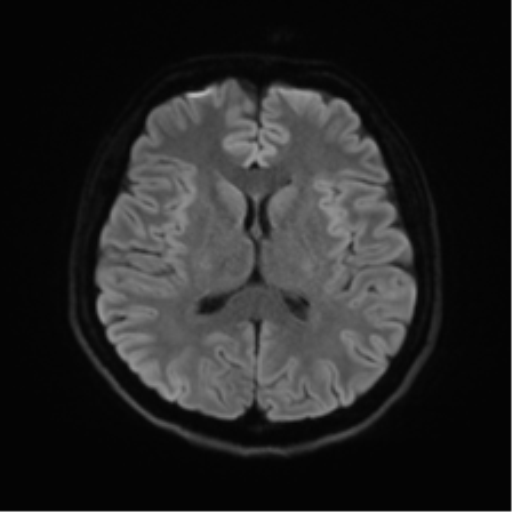 Abducens nerve palsy (Radiopaedia 51069-56648 Axial DWI 42).png