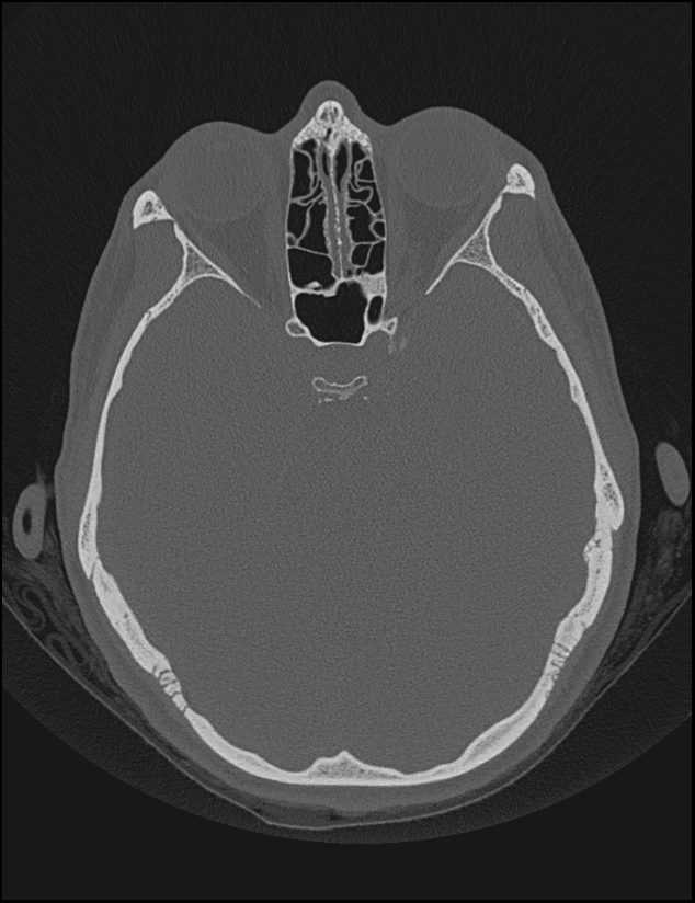 Aberrant right internal carotid artery (Radiopaedia 65191-74198 Axial non-contrast 68).jpg