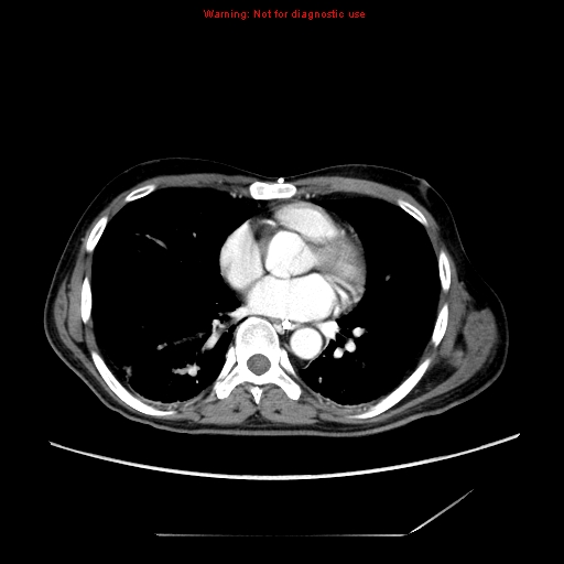 Aberrant right subclavian artery (Radiopaedia 9379-10071 Axial C+ arterial phase 39).jpg