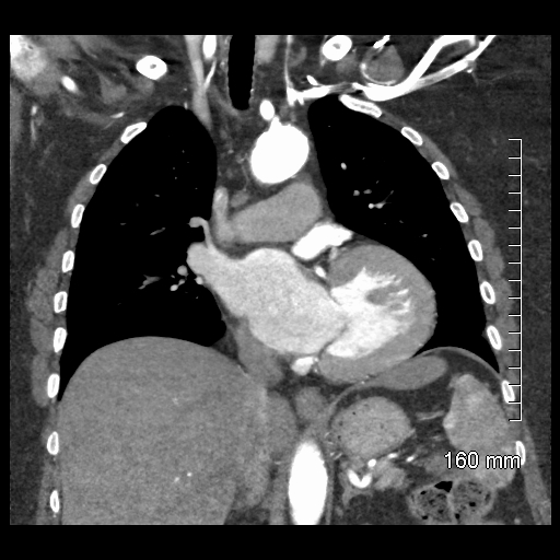 File:Aberrant right subclavian artery stenosis (Radiopaedia 52656-58670 B 44).jpg
