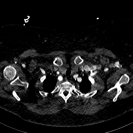 File:Aberrant right subclavian artery with Kommerell diverticulum (Radiopaedia 47982-52769 Axial C+ arterial phase 12).png
