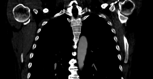 Accesory rib joint (Radiopaedia 71987-82452 Coronal bone window 22).jpg