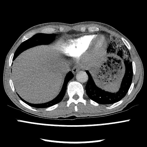 File:Accessory left horizontal fissure with lingular pneumonia (Radiopaedia 53763-59843 Axial C+ CTPA 75).jpg