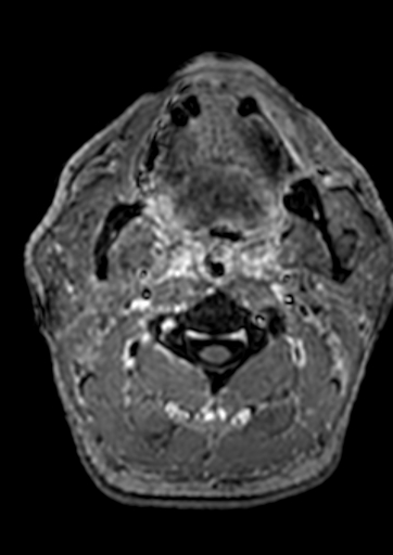 Accessory middle cerebral artery (Radiopaedia 73114-83828 Axial T1 C+ 259).jpg