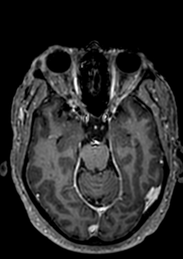 File:Accessory middle cerebral artery (Radiopaedia 73114-83828 Axial T1 C+ 86).jpg