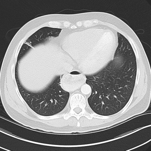 File:Achalasia of the cardia (Radiopaedia 38497-40595 Axial lung window 39).png
