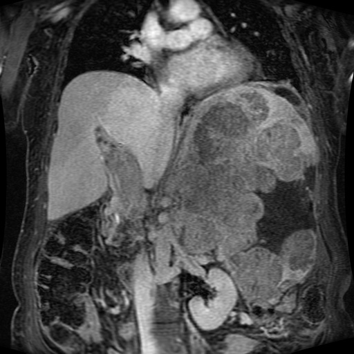 Acinar cell carcinoma of the pancreas (Radiopaedia 75442-86668 Coronal T1 C+ fat sat 100).jpg