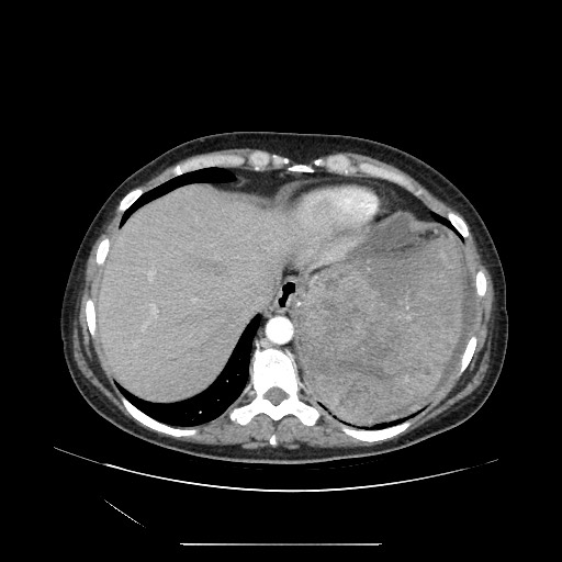 File:Acinar cell carcinoma of the pancreas (Radiopaedia 75442-86669 Axial C+ portal venous phase 17).jpg