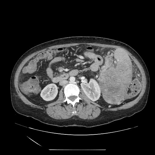 Acinar cell carcinoma of the pancreas (Radiopaedia 75442-86669 Axial C+ portal venous phase 67).jpg