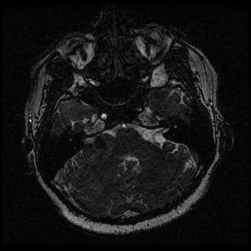File:Acoustic schwannoma (Radiopaedia 33045-34060 Axial T2 28).png