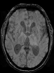 File:Acoustic schwannoma (Radiopaedia 55729-62281 Axial SWI 26).png