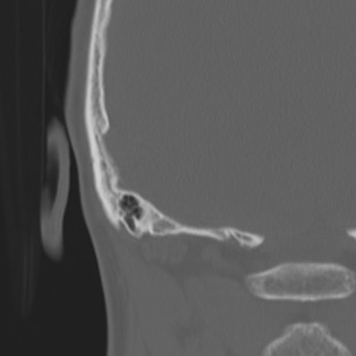 Acoustic schwannoma - eroding petrous apex (Radiopaedia 39674-42002 Coronal bone window 49).png
