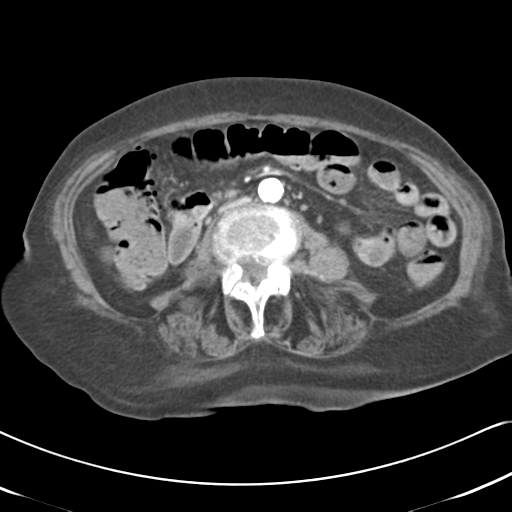 Active bleeding from duodenal ulcer with embolization (Radiopaedia 34216-35481 C 31).png