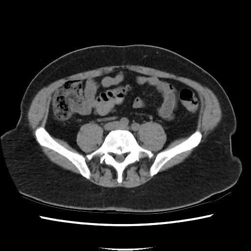Active colonic bleed on CT (Radiopaedia 49765-55025 Axial non-contrast 55).jpg