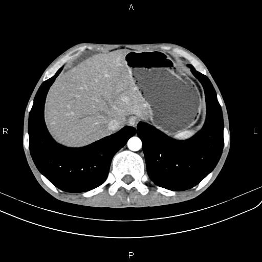 Active crohn disease (Radiopaedia 87133-103397 Axial C+ arterial phase 16).jpg